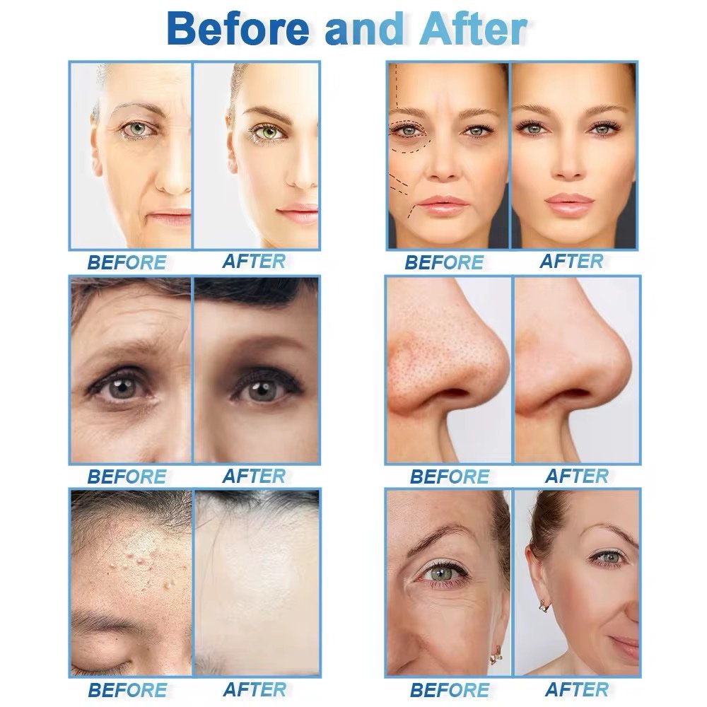 Hydra Beauty 18 in 1 – جهاز هيدرافيشل 18 وظيفة الشكل الجديد لتنظيف وتجديد البشرة | New Edition 18 Function - Image 4