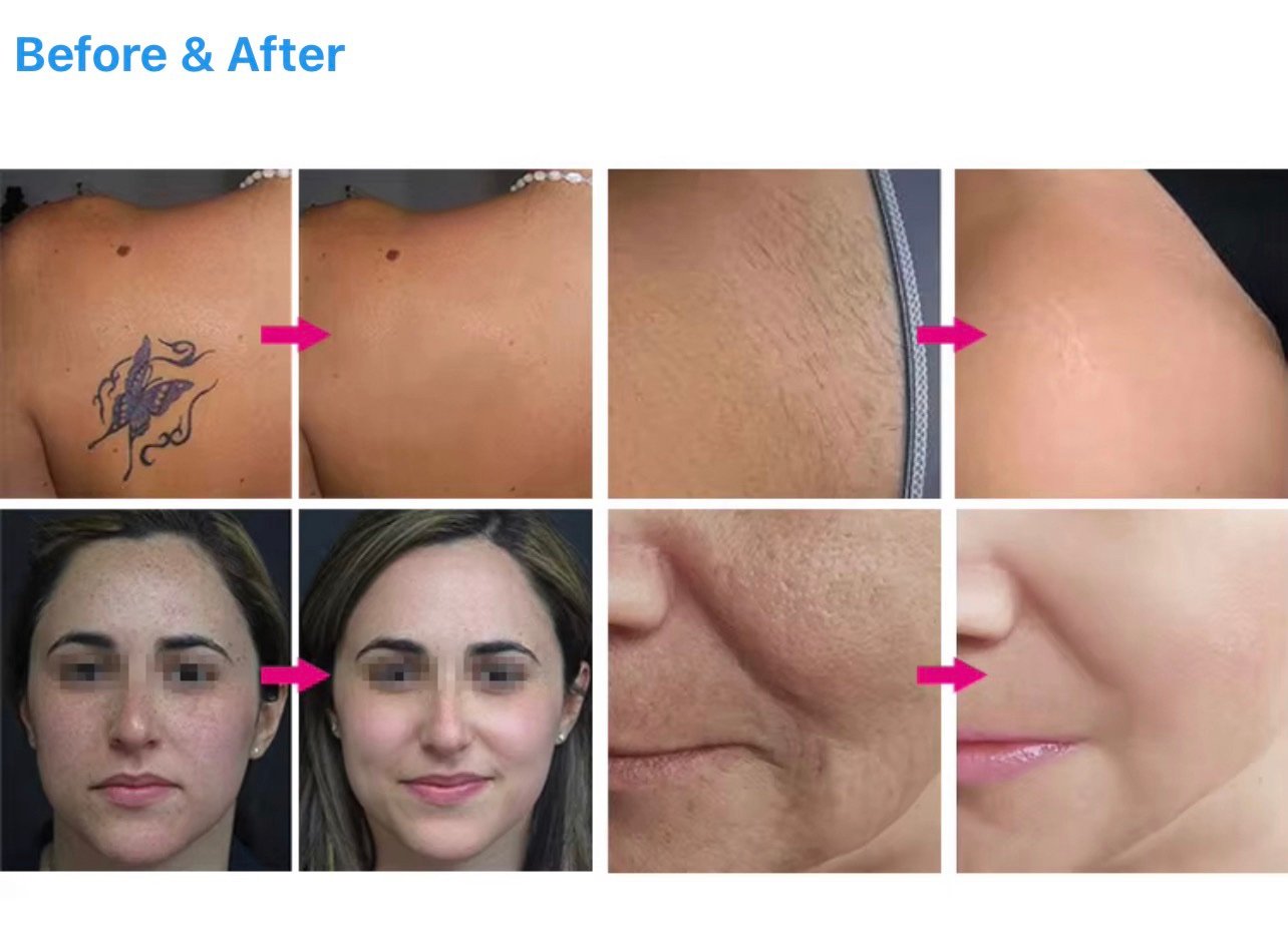 808nm + 755nm + 1064nm Triple Wavelength Diode Laser – جهاز ليزر ديود لإزالة الشعر ثلاثي الموجات - Image 7